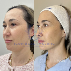 Виваче + полимолочная кислота